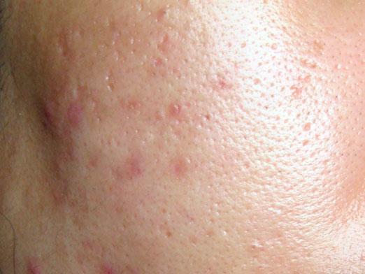 Como se livrar de vestígios de acne?