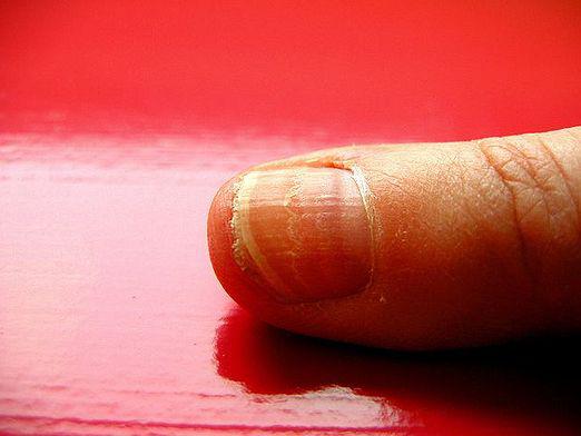 Por que as unhas estão rachadas?