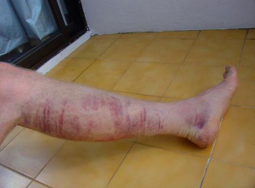 O que é hematoma?